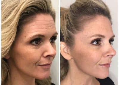 Botox, Dysport, Xeomin before and after photos from Cúrate MedAesthetics in Chattanooga TN