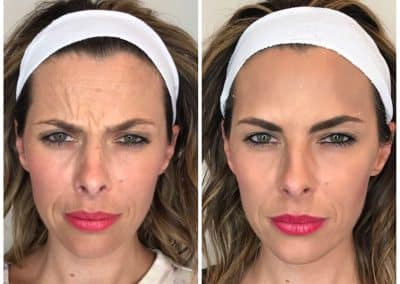 Botox, Dysport, Xeomin before and after photos from Cúrate MedAesthetics in Chattanooga TN