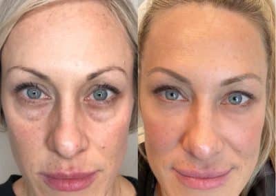 Dermal Fillers before and after photos from Cúrate MedAesthetics in Chattanooga TN