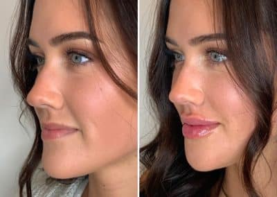 Dermal Fillers before and after photos from Cúrate MedAesthetics in Chattanooga TN