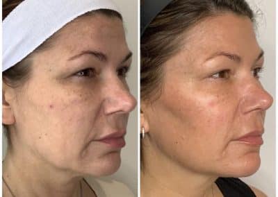 Sculptra before and after photos from Cúrate MedAesthetics in Chattanooga TN